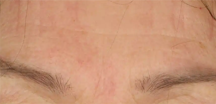 Close-up of person's forehead with sparse eyebrows.