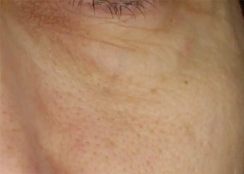 Close-up of human skin with visible pores and lines.