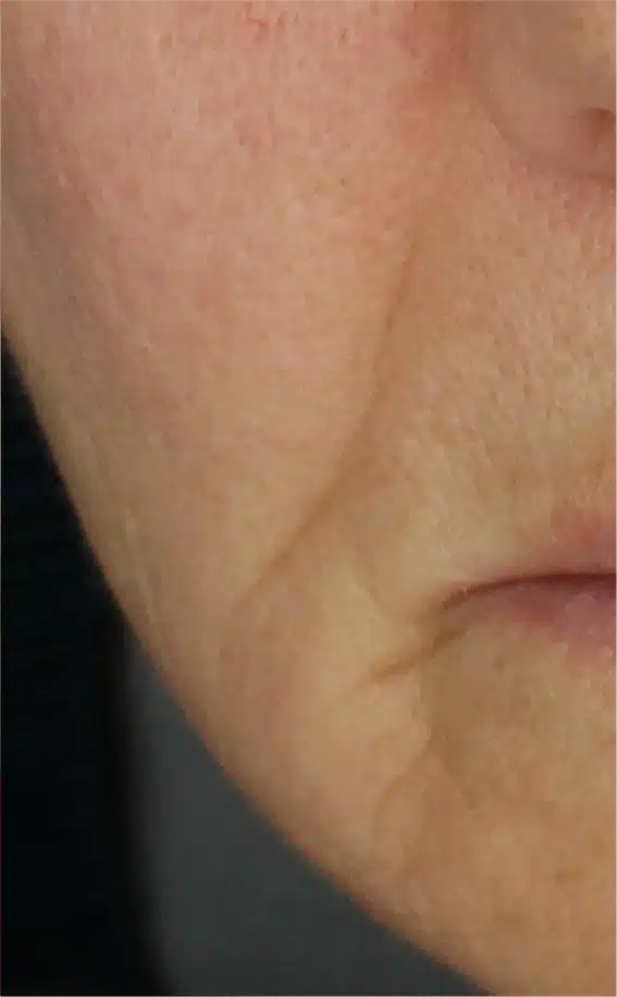 Close-up of person's cheek and nose.