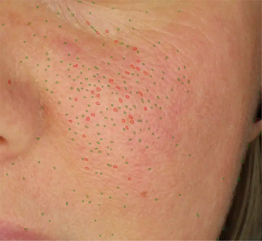 Close-up of cheek with multicolored pore mapping.