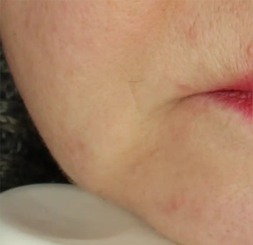 Close-up of a minor facial wound on skin.